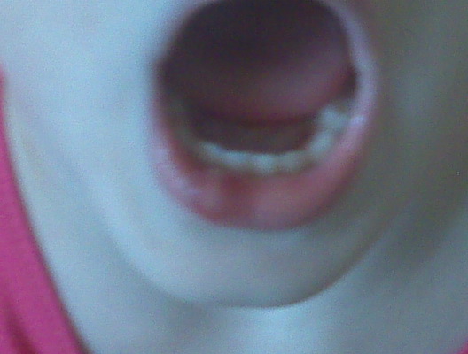 fat lip 2